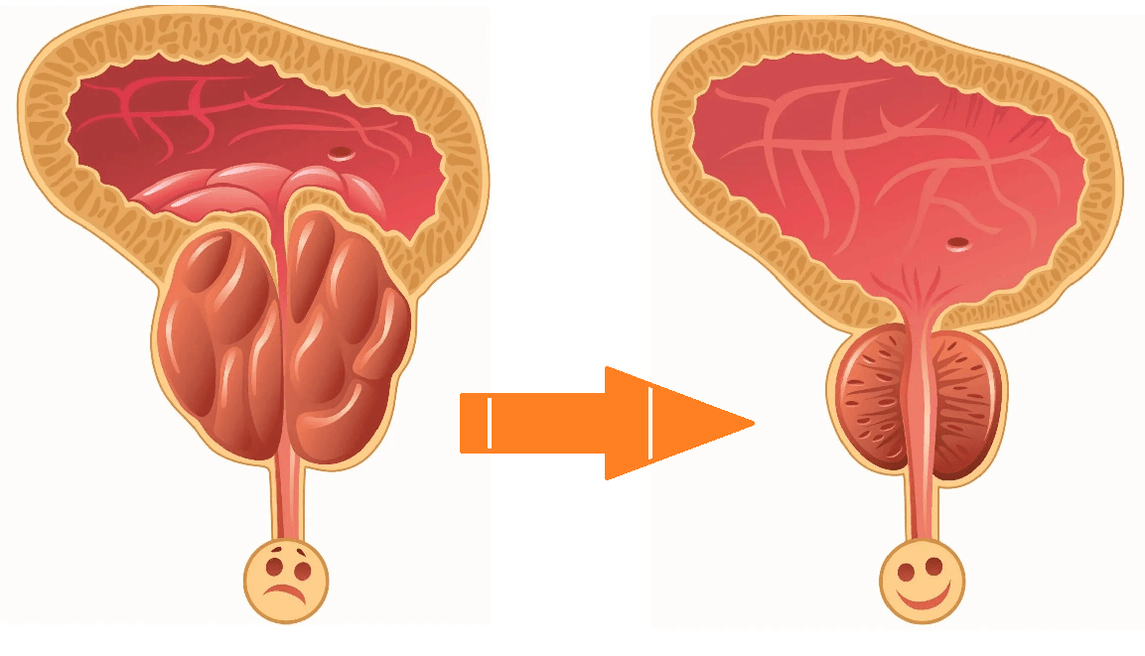 Uromexil Forte Efecto na próstata con prostatite e adenoma
