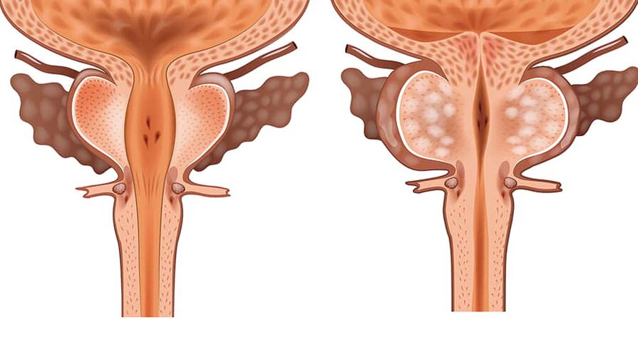 Comparación de adenoma san e inflamado