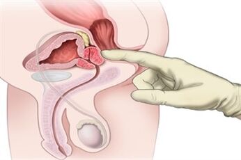 Masaxe de próstata para o tratamento da prostatite crónica
